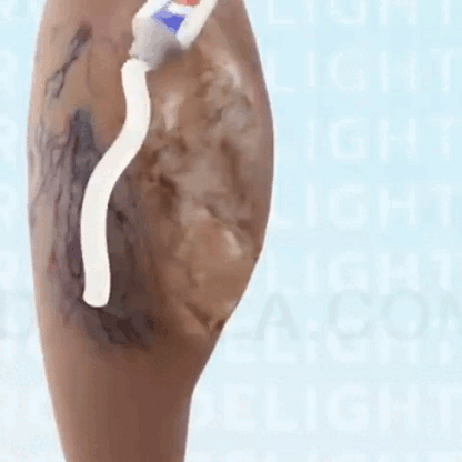 VARICOSE: La Solución Definitiva contra Varices